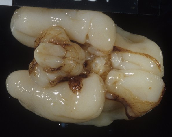 9A2 Normal Fetal Brain 21 wk (Case 9) 2