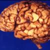 1 Brain, 40 week gestation neonate (Case 1) 1