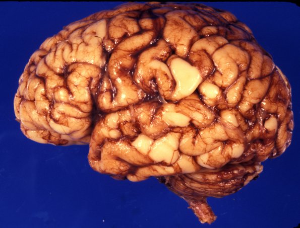 1 Brain, 40 week gestation neonate (Case 1) 1