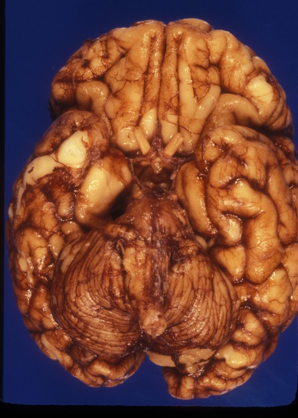 1A2 Brain, term (Case 1) 2