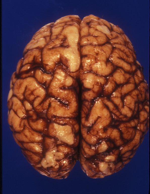 1A3 Brain, term (Case 1) 3