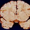 1A6 Brain, neonate (Case 1) 3