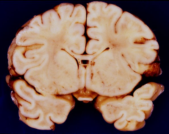 1A6 Brain, neonate (Case 1) 3