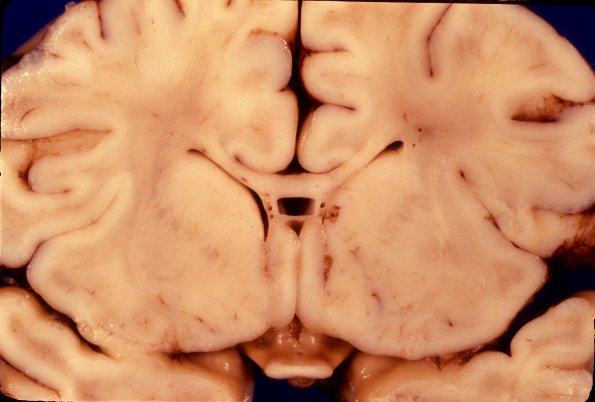 1A7 Brain, term (Case 1) 6