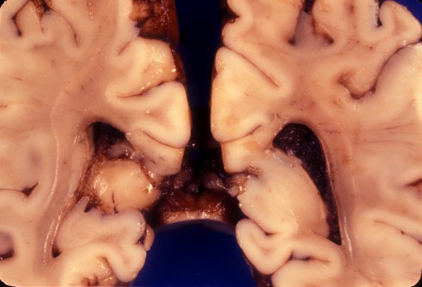 1A9 Brain, term (Case 1) 5