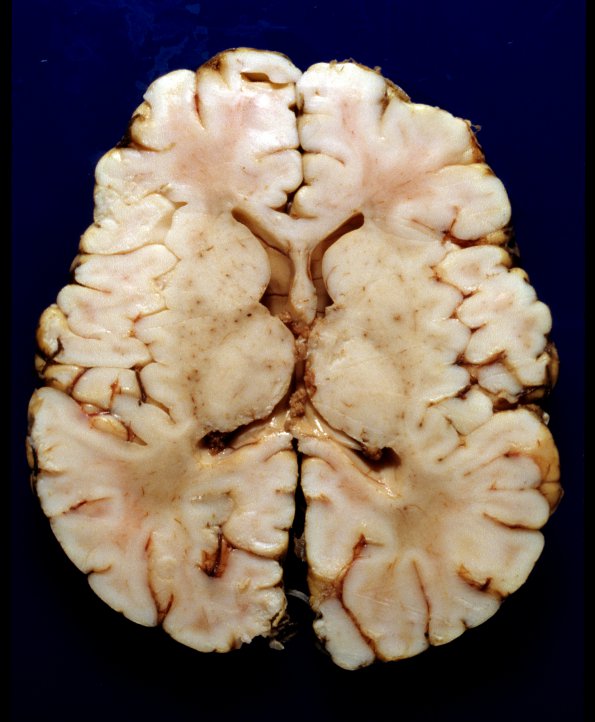 2 Newborn Brain (Case 2)