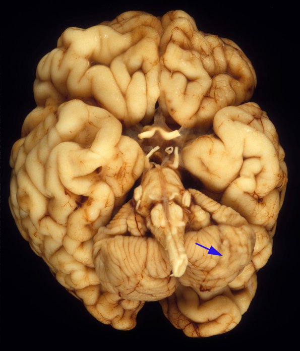 1A2 CHARGE syndrome (Case 1) 2