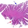 1B1 CHARGE syndrome (Case 1) N9 H&E whole mount