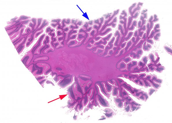 1B1 CHARGE syndrome (Case 1) N9 H&E whole mount