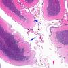 1B2 CHARGE syndrome (Case 1) N9 H&E 11