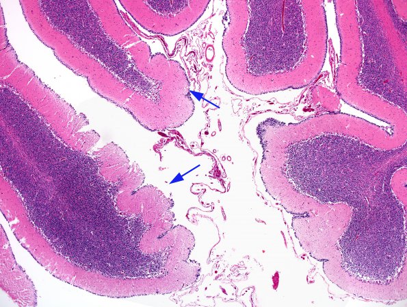 1B2 CHARGE syndrome (Case 1) N9 H&E 11