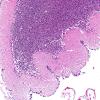 1B3 CHARGE syndrome (Case 1) N9 H&E 4