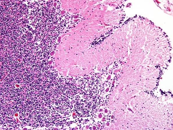 1B4 CHARGE syndrome (Case 1) N9 H&E 12