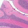 1B5 CHARGE syndrome (Case 1) N9 H&E 1