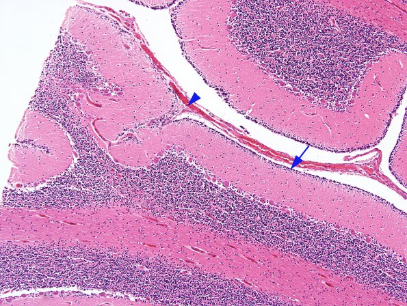 1B5 CHARGE syndrome (Case 1) N9 H&E 1