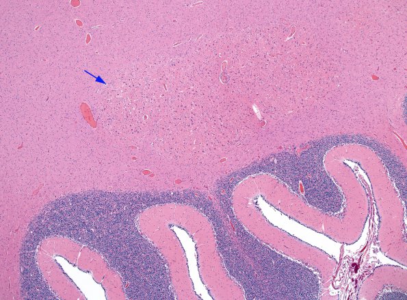 1B6 CHARGE syndrome (Case 1) N9 H&E 8