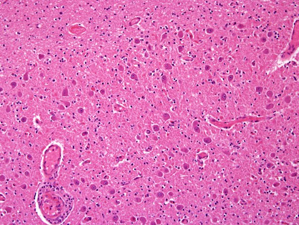 1B7 CHARGE syndrome (Case 1) N9 H&E 2