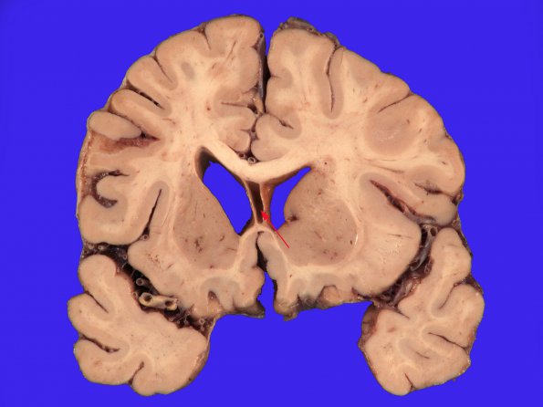 1 Cavum Septum Pellucidum (Case 1) 3