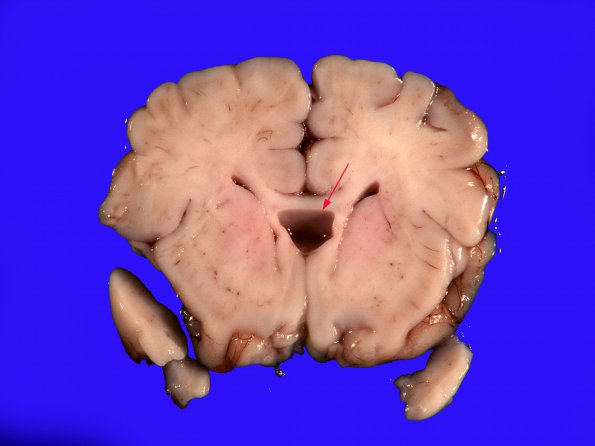 2A1 Cavum Septum Pellucidum (Case 2)_1