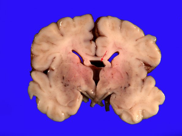 2A2 Cavum Vergae (Case 2)_2