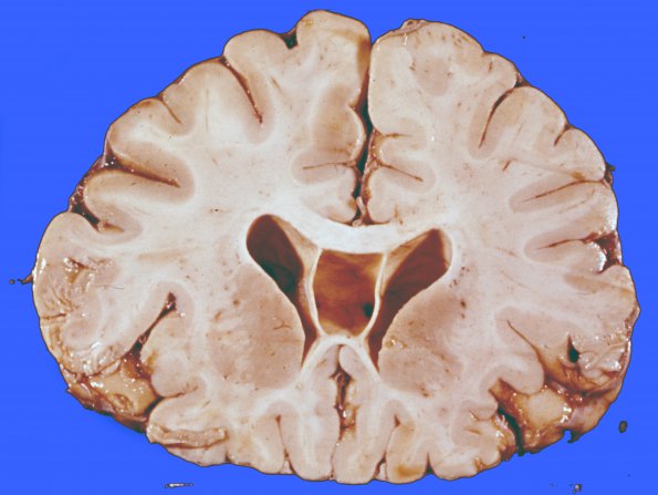 4 Cavum Septum Pellucidum (Case 5) 2