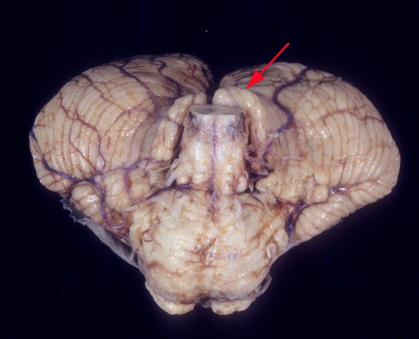 1A1 Malformation, Chiari Type I (Case 1) 2