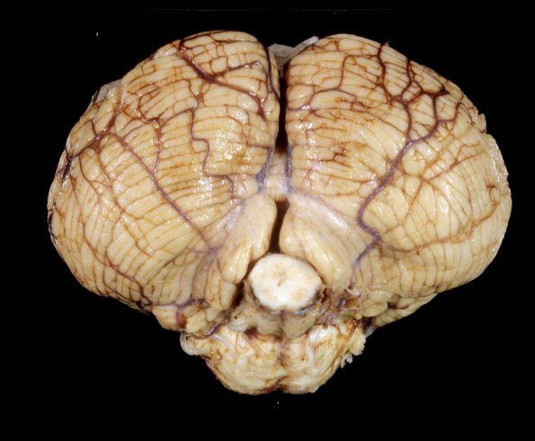 1A2 Malformation, Chiari Type I (Case 1) 3