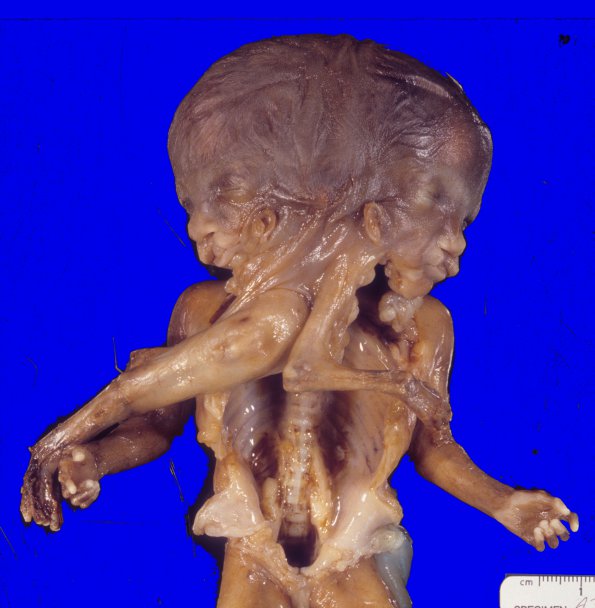 1A1 Conjoined Twins, 2 cerebra, asymmetric brainstem & cerebellum (Case 1) 2A