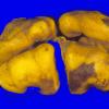 1A3 Conjoined Twins, 2 cerebra, asymmetric brainstem & cerebellum (Case 1) 6A