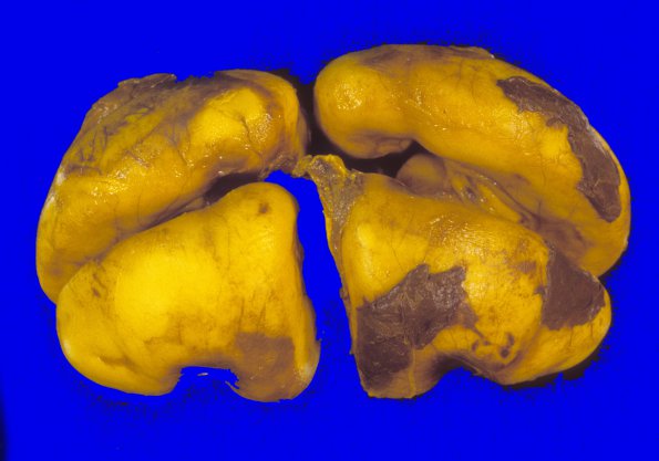 1A3 Conjoined Twins, 2 cerebra, asymmetric brainstem & cerebellum (Case 1) 6A