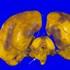 1A4 Conjoined Twins, 2 cerebra, asymmetric brainstem & cerebellum (Case 1) 4A