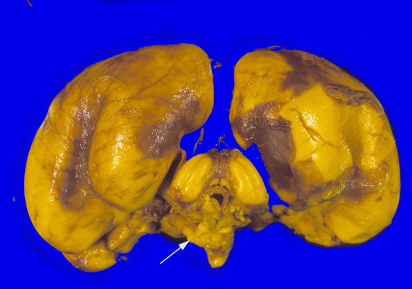 1A4 Conjoined Twins, 2 cerebra, asymmetric brainstem & cerebellum (Case 1) 4A