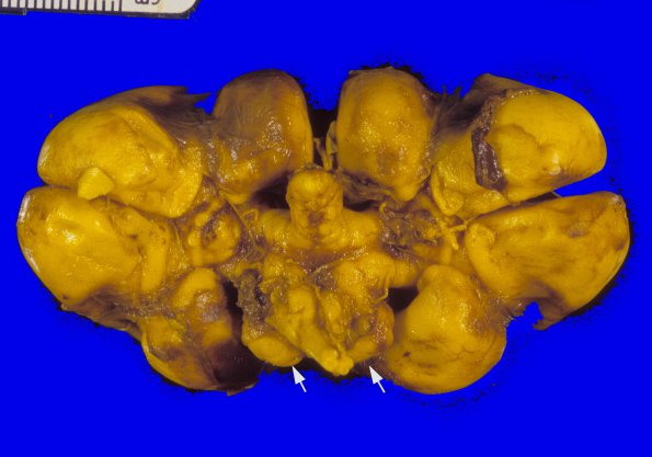 1A5 Conjoined Twins, 2 cerebam, asymmetric brainstem & cerebellum (Case 1) 5A