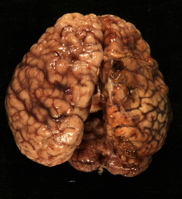 1A1 Crossed cerebellar atrophy, Infarct, agenesis corpus callosum (Case 1) 1