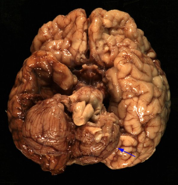 1A2 Crossed cerebellar atrophy, Infarct, agenesis corpus callosum (Case 1) 2