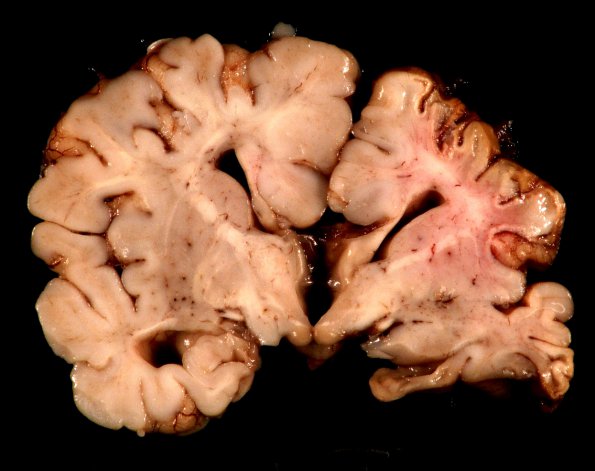 1A3 Crossed cerebellar atrophy, Infarct, agenesis corpus callosum (Case 1) 4