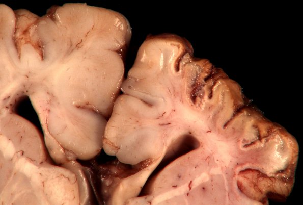 1A4 Crossed cerebellar atrophy, Infarct, agenesis corpus callosum (Case 1) 10