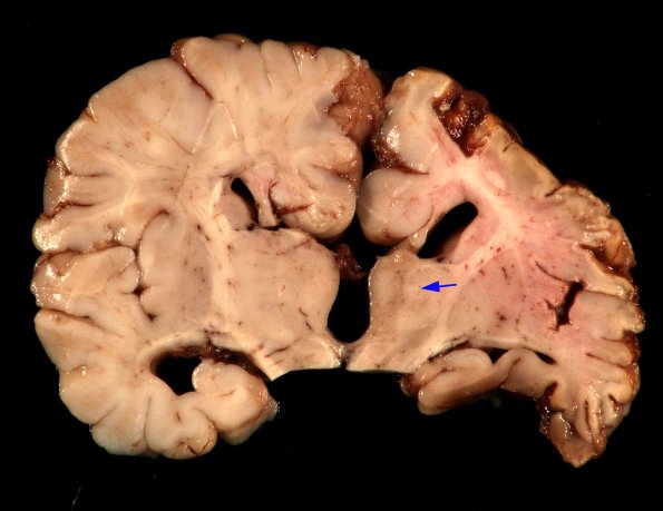 11A5 Crossed cerebellar atrophy, Infarct, agenesis corpus callosum (Case 1) 5