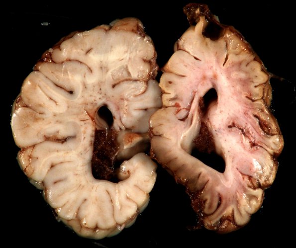 1A6 Crossed cerebellar atrophy, Infarct, agenesis corpus callosum (Case 1)