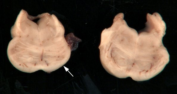 1A7 Crossed cerebellar atrophy, Infarct, agenesis corpus callosum (Case 1) Pons