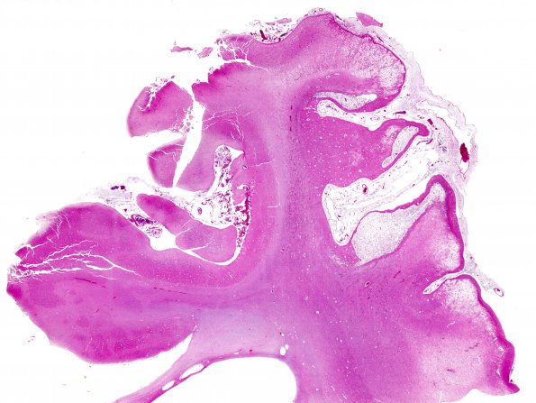 1B1 Crossed cerebellar atrophy, Infarct, agenesis corpus callosum (Case 1) H&E