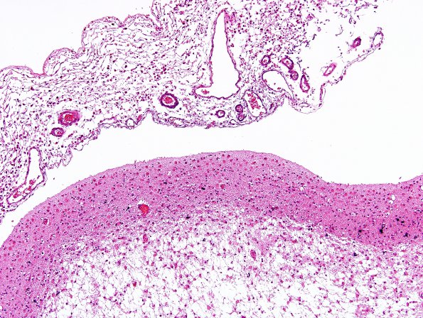 1B2 Crossed cerebellar atrophy, Infarct, agenesis corpus callosum (Case 1) H&E 2