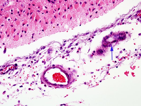 1B3 Crossed cerebellar atrophy, Infarct, agenesis corpus callosum (Case 1) H&E 5 Ca A