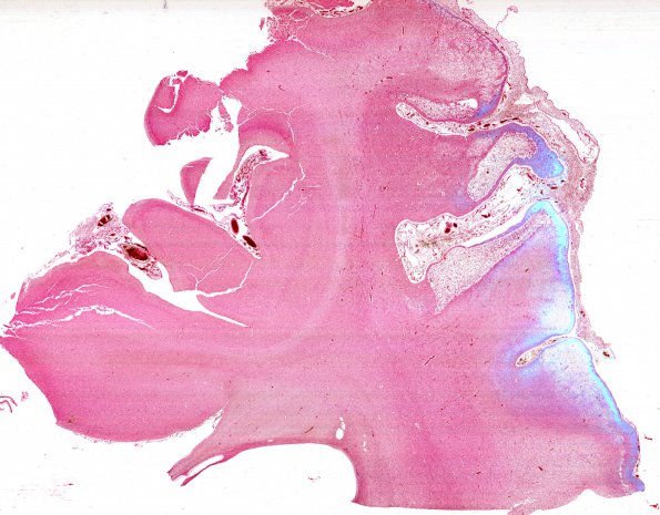 1B4 Crossed cerebellar atrophy, Infarct, agenesis corpus callosum (Case 1) N16 Iron