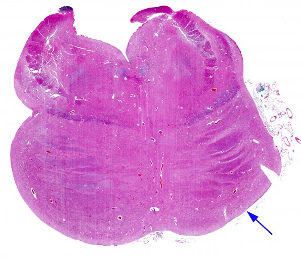 1B5 Crossed cerebellar atrophy, Infarct, agenesis corpus callosum (Case 1) N7 (right notch) H&E