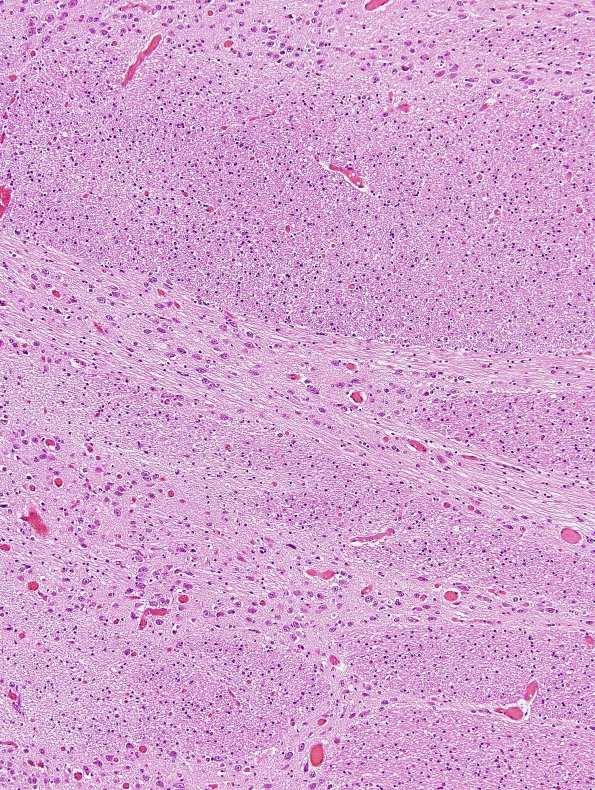 1B6 Crossed cerebellar atrophy, Infarct, agenesis corpus callosum (Case 1) Pons H&E L2