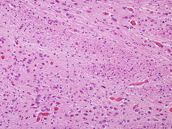 1B7 Crossed cerebellar atrophy, Infarct, agenesis corpus callosum (Case 1) Pons H&E L1