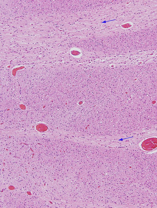 1B8 Crossed cerebellar atrophy, Infarct, agenesis corpus callosum (Case 1) Pons H&E R2