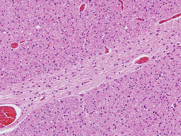 1B9 Crossed cerebellar atrophy, Infarct, agenesis corpus callosum (Case 1) Pons H&E R1