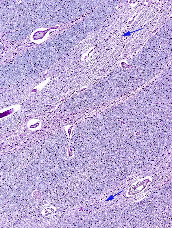 1C2 Crossed cerebellar atrophy, Infarct, agenesis corpus callosum (Case 1)  LFB-PAS 720